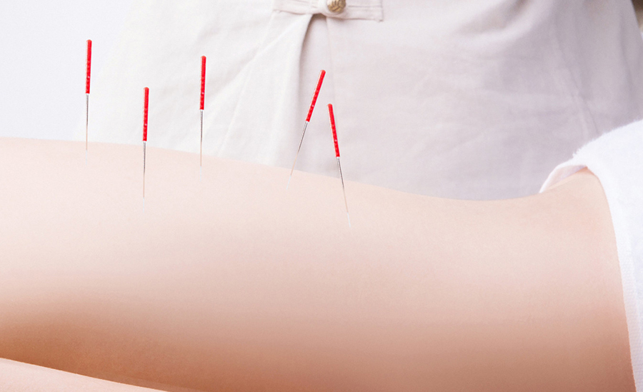 Unlock the Power of Fu’s Subcutaneous Needling: A Modern Approach to Holistic Healing